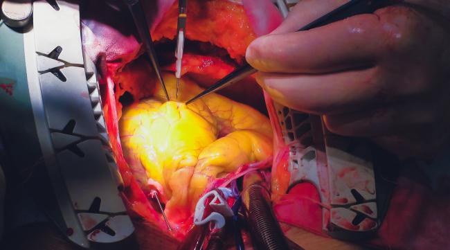 心脏手术是怎么回事
