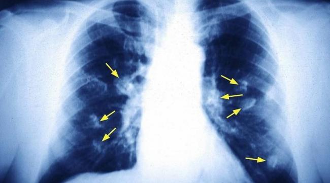 IA期肺腺癌复发率高吗